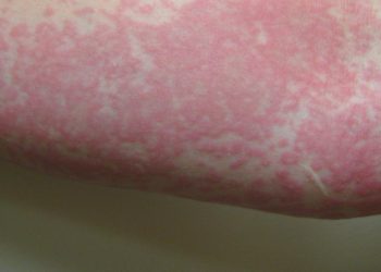 Sering Biduran Tanda Penyakit Apa Penyebab Penanganan dan Kapan Harus ke Dokter