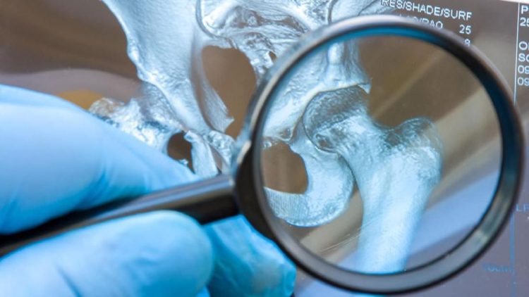 Faktor Keturunan Memicu Asam Urat, Ini Penjelasan dari Ahli