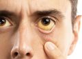 Delapan Penyebab Mata Menguning Selain Hepatitis