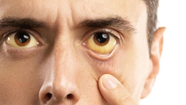 Delapan Penyebab Mata Menguning Selain Hepatitis