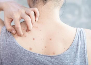 8 Cara Mengatasi Jerawat Punggung yang Tak Kunjung Hilang