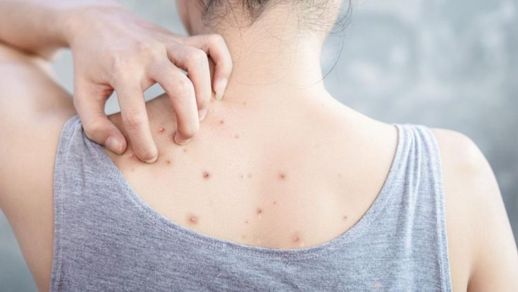 8 Cara Mengatasi Jerawat Punggung yang Tak Kunjung Hilang